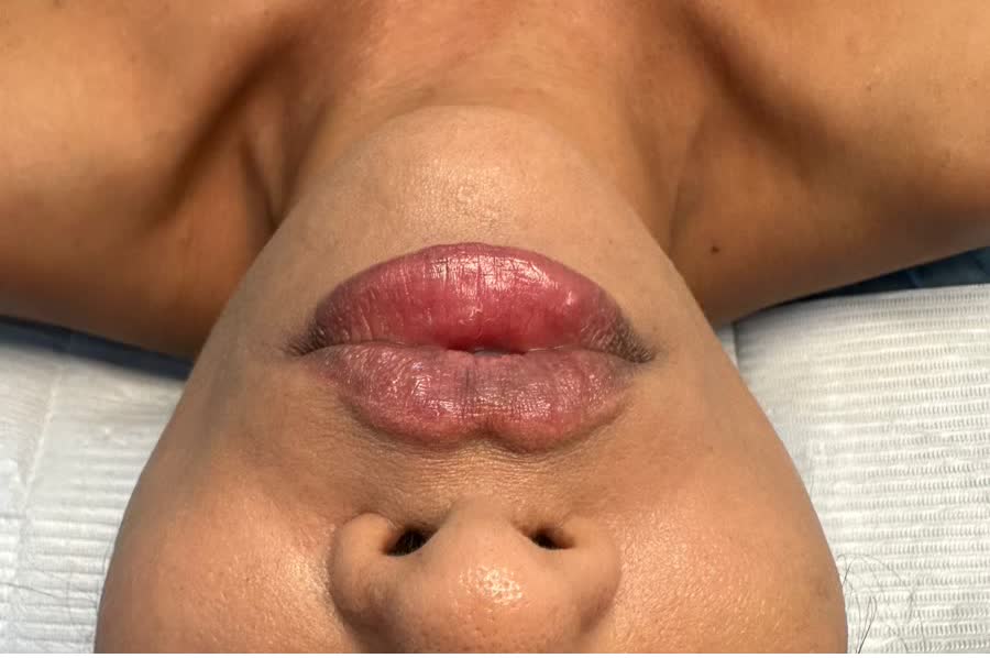 Lips after filler treatment