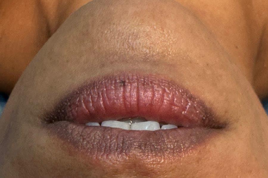 Lips before treatment
