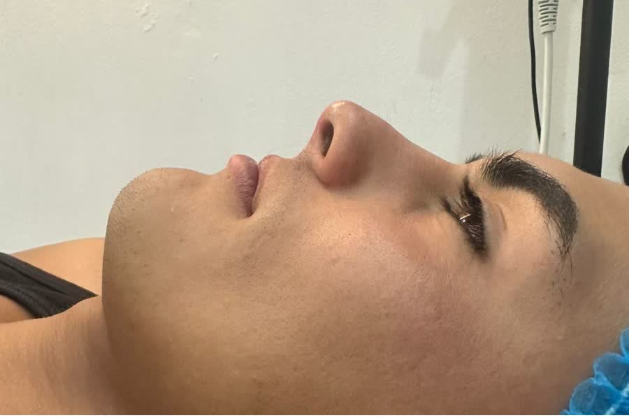 Nose profile after liquid rhinoplasty