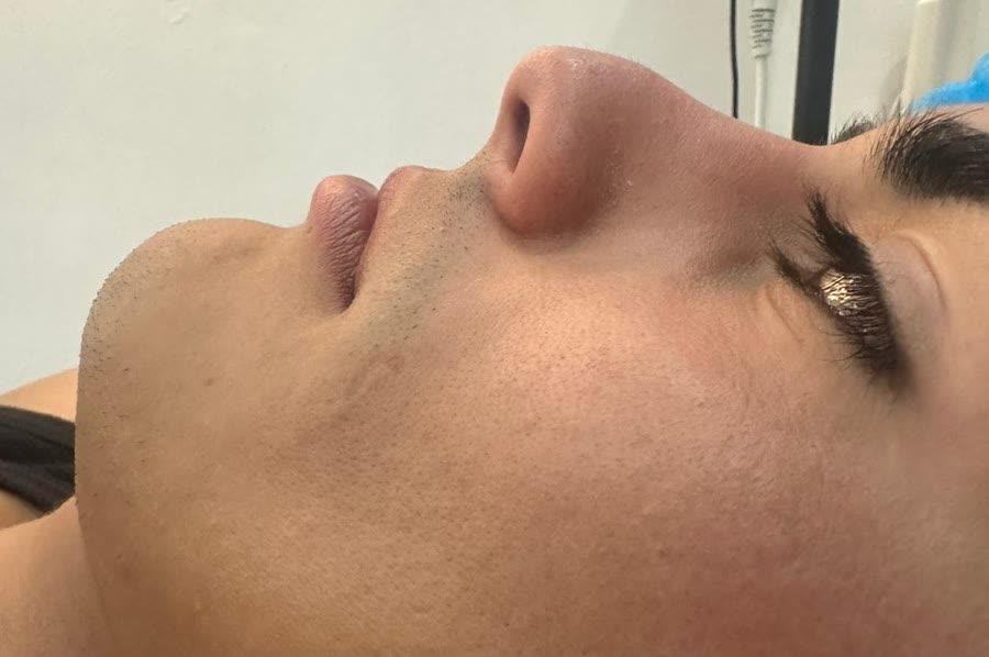 Nose profile before liquid rhinoplasty