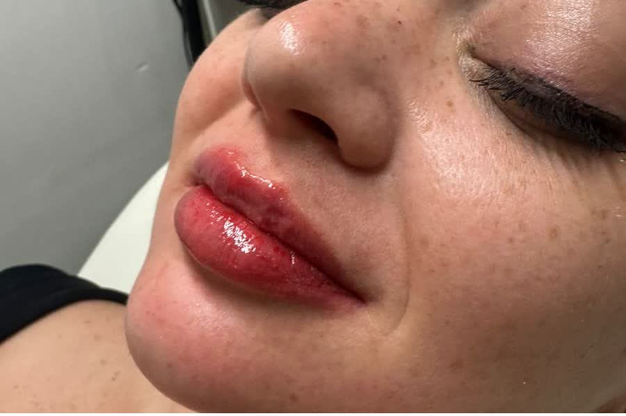 Face after contouring treatment
