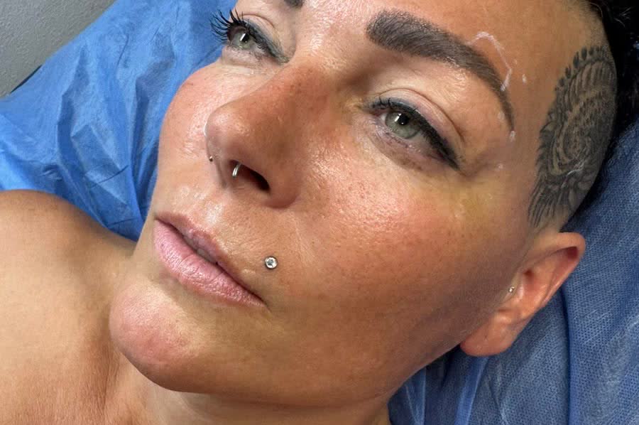 Profile before nose refinement